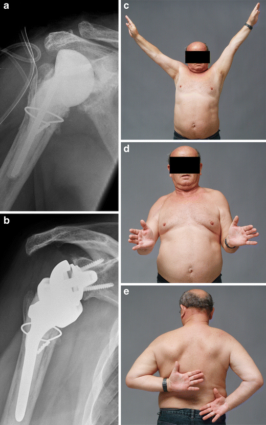Reverse total shoulder arthroplasty—from the most to the least common