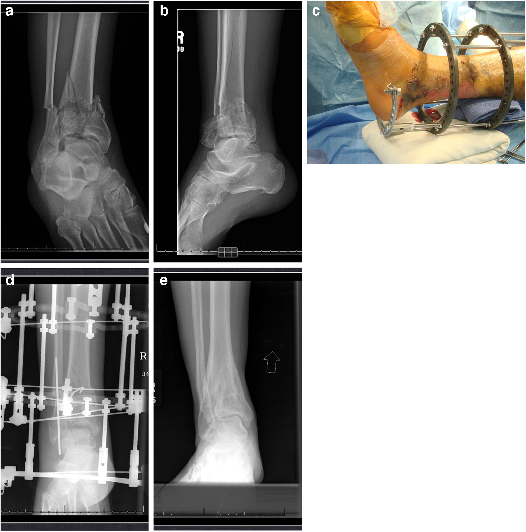 High Energy Tibial Pilon Fractures An Instructional Review