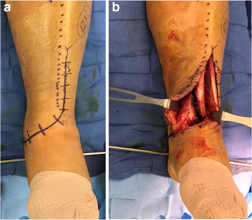 Pilon fracture wounds