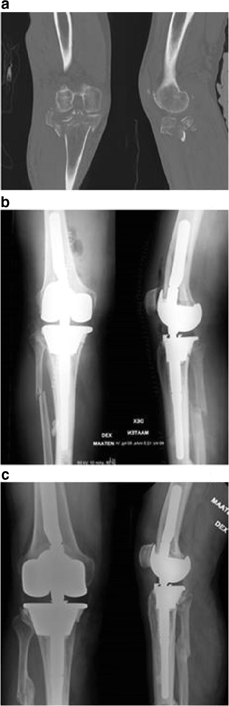 Knee Joint Replacement As Primary Treatment For Proximal