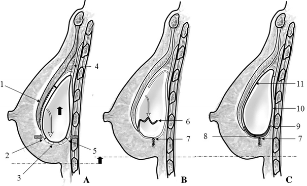 Capsular Defect Closure Capsular Flaps for the Management of Malpositioned Implants After ...
