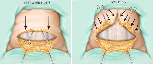 “Inverted-Y”: A Modified Vest-Over-Pants Abdominoplasty Pattern