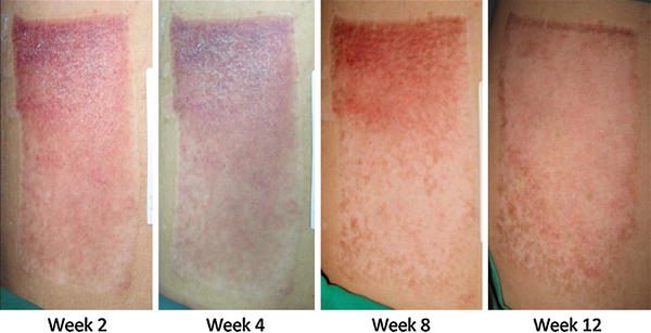 the-efficacy-of-combined-herbal-extracts-gel-in-reducing-scar