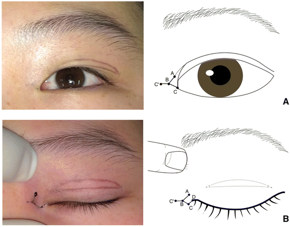 A Novel U Flap Epicanthoplasty For Asian Patients Springerlink