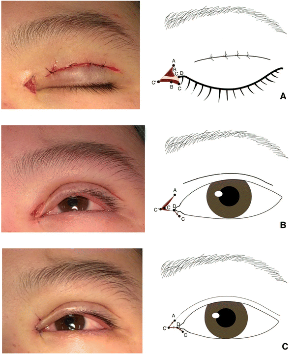 A Novel U Flap Epicanthoplasty For Asian Patients Springerlink