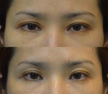 Epicanthal Restoration Surgery With Scar Excision In Severe