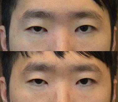 Epicanthal Restoration Surgery With Scar Excision In Severe