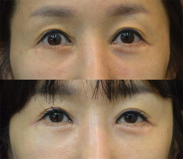 Epicanthal Restoration Surgery With Scar Excision In Severe