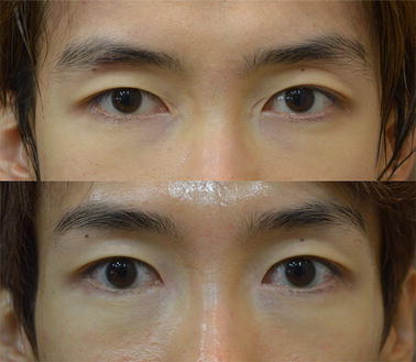 Epicanthal Restoration Surgery With Scar Excision In Severe
