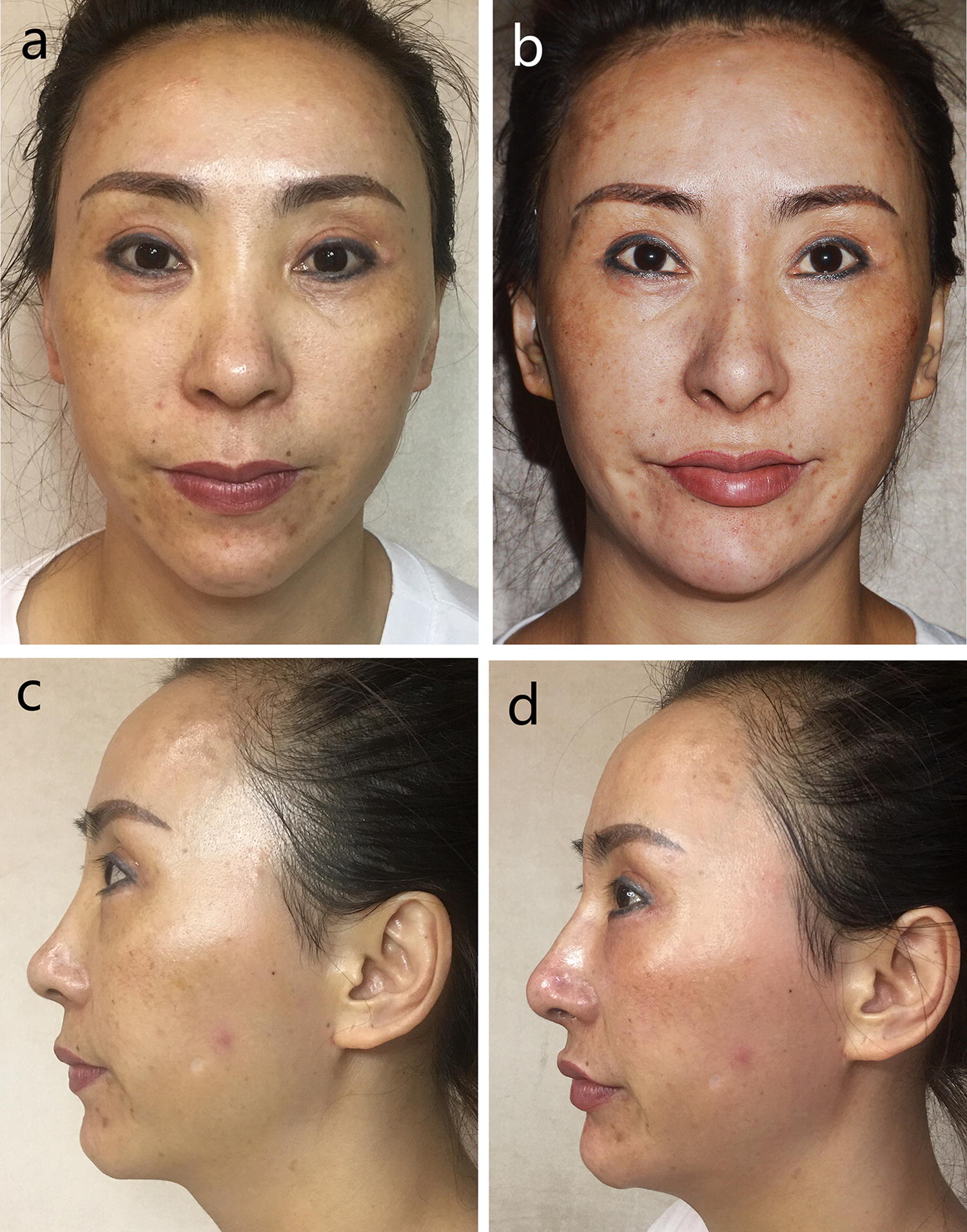 mentolabial fold filler