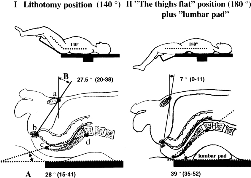 “On Table” Positioning for Optimal Access for Cancer Excision in the