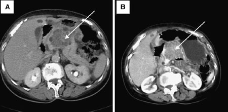 Benign Peritoneal Cystic Mesothelioma | SpringerLink