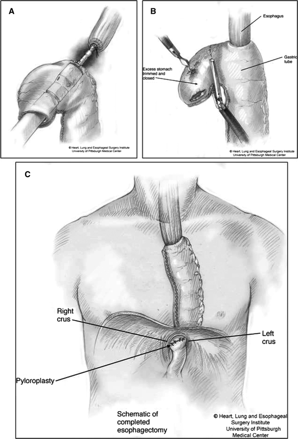 Minimally Invasive Esophagectomy The Evolution and Technique of Minimally Invasive Surgery for