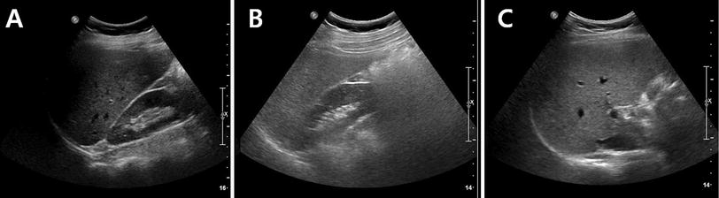 Cholecystectomy Causes Ultrasound Evidence of Increased Hepatic ...