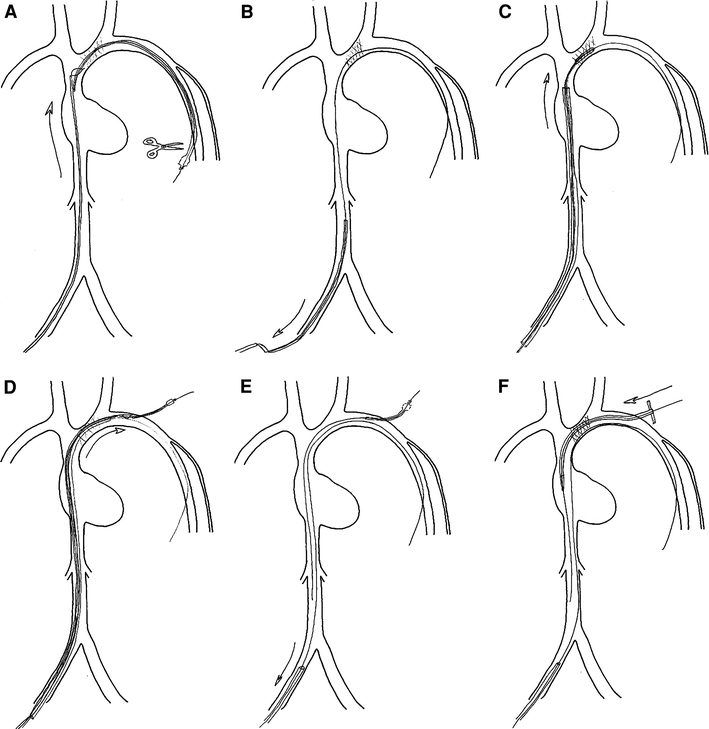 femoral vein triple lumen catheter placement