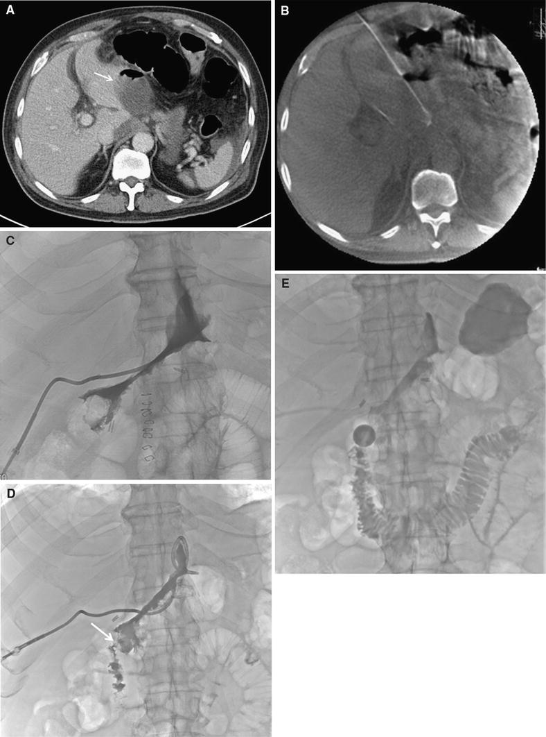 Percutaneous Management of Postoperative Duodenal Stump Leakage with
