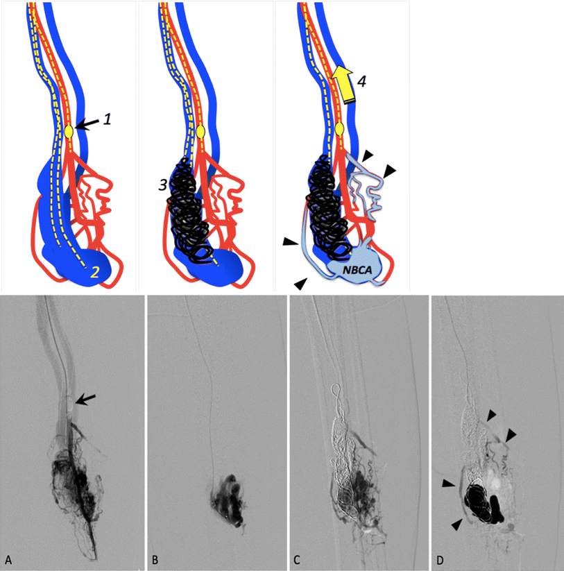 A Retrograde Transvenous Embolization Technique with BalloonAssisted