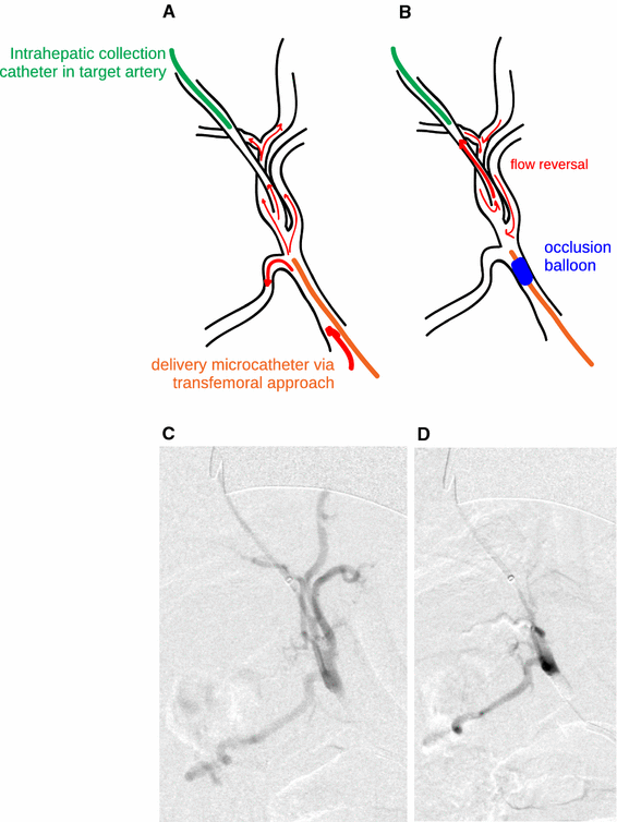 PressureDirected Embolization of Hepatic Arteries in a Porcine Model