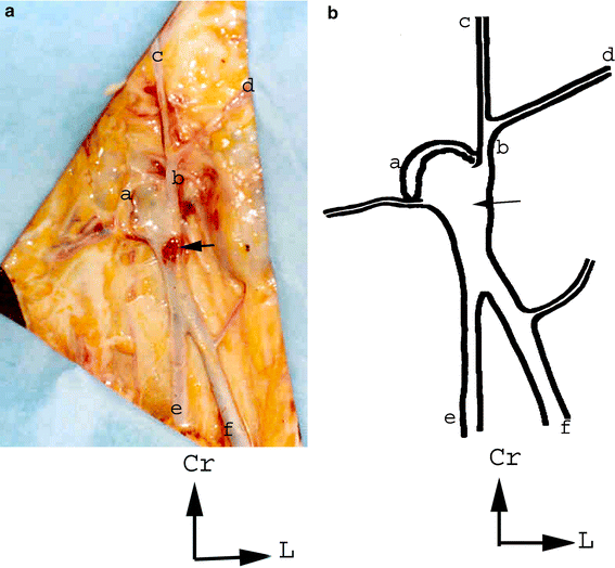 The arch of the great saphenous vein: anatomical bases for failures and