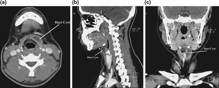 Thyroglossal duct cysts: anatomy, embryology and treatment | SpringerLink