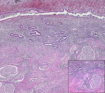 erosion und ektropium der cervix uteri deutsch