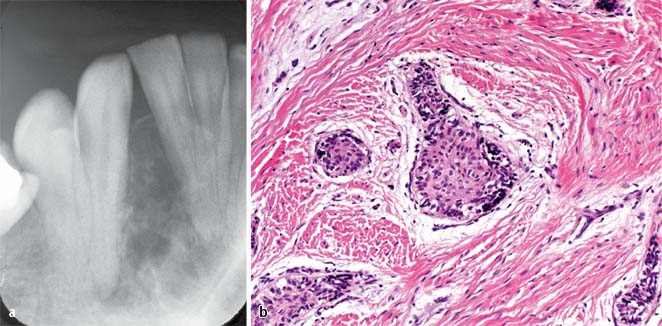 Benigne epitheliale odontogene Tumoren SpringerLink