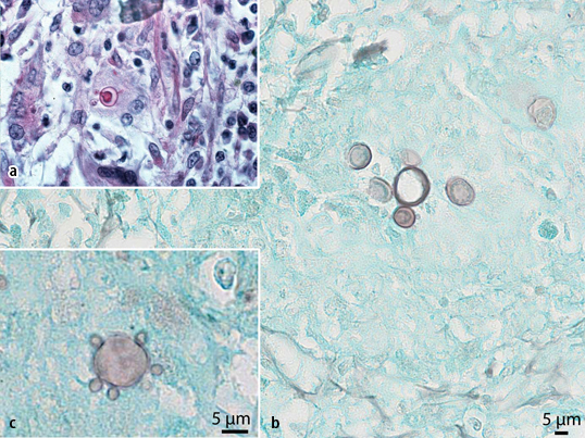 Differenzialdiagnosen beim Nachweis von Hefen und ...