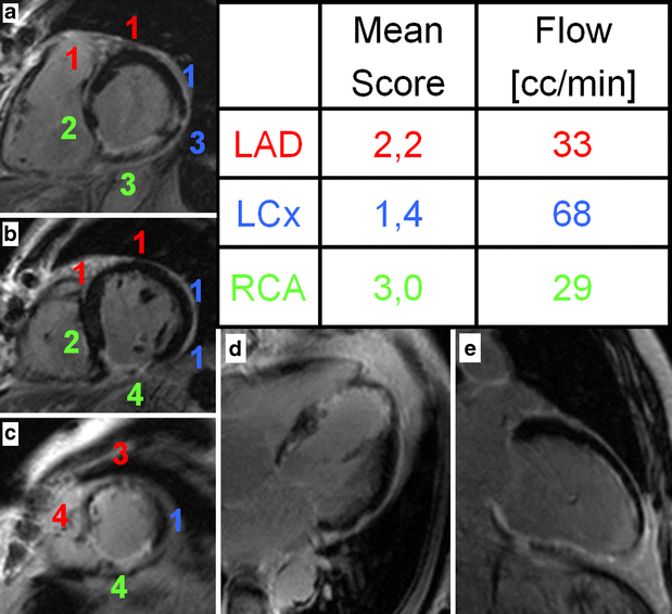 Contrastenhanced cardiac MRI before coronary artery bypass surgery