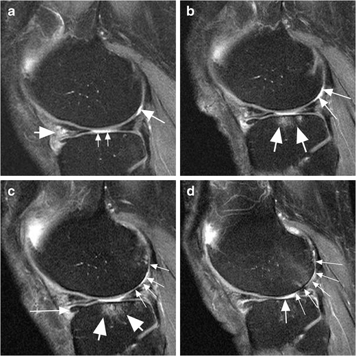 An update on risk factors for cartilage loss in knee osteoarthritis