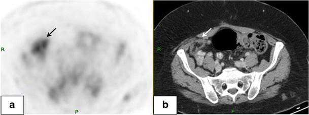 Fat necrosis after abdominal surgery: A pitfall in interpretation of ...