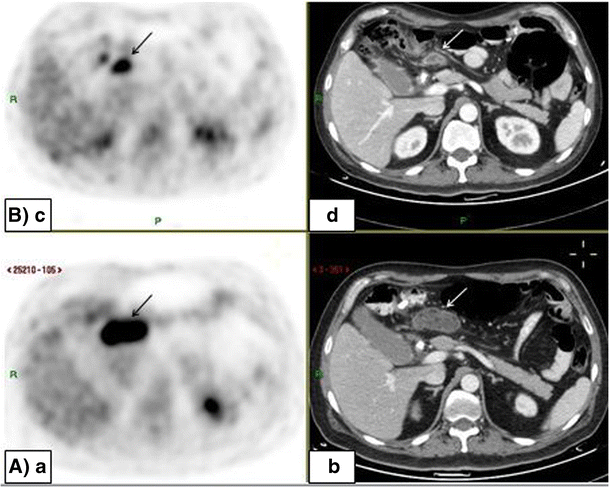 Fat necrosis after abdominal surgery: A pitfall in interpretation of ...
