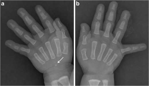 Bone Age Wrist Chart