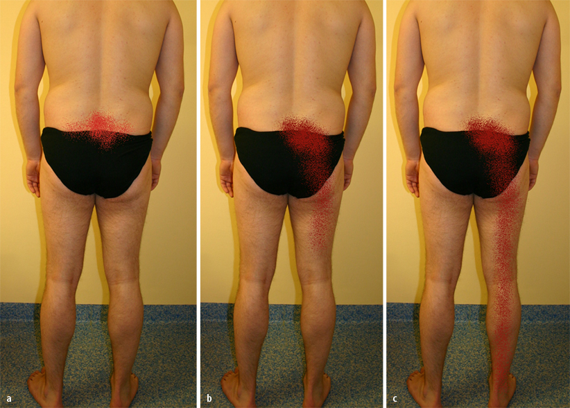 Manualmedizinische Syndrome bei unteren Rückenschmerzen: Teil I