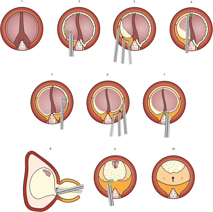 Common trend: move to enucleation—Is there a case for GreenLight ...