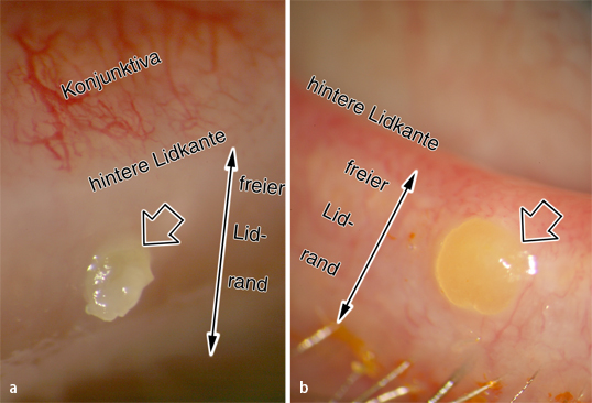 Meibom-Drüsen | SpringerLink