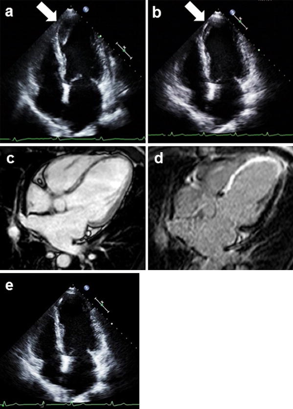 Successful resolution of a left ventricular thrombus with apixaban treatment following acute ...