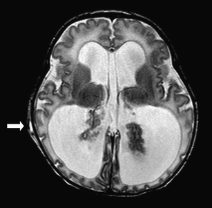 Bilateral choroid plexus hyperplasia: a case report and management ...