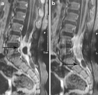 Spinal dermal sinus tract | SpringerLink