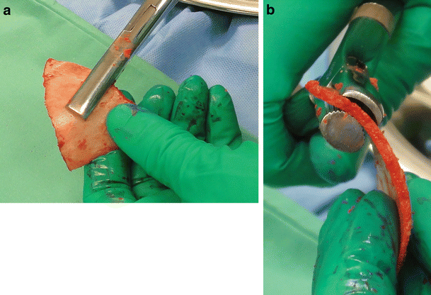 Split calvarial bone grafting in patients less than 1 year of age