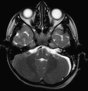 internal auditory canal cyst internal auditory canal cyst