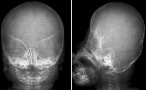 Diagnostic features of prematurely fused cranial sutures on plain skull ...