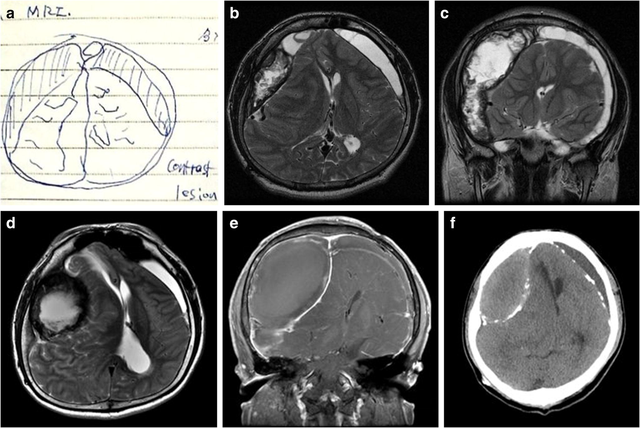 dating subdural hematom MRI