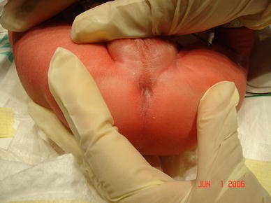 itchy near Pediatric anus growth