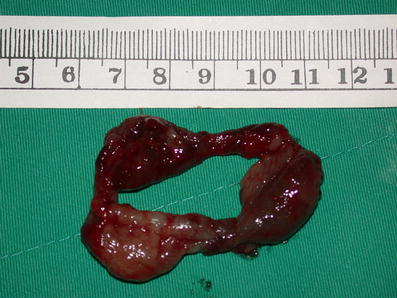 hemorrhoids stapled hemorrhoidopexy hemorrhoids stapled hemorrhoidopexy