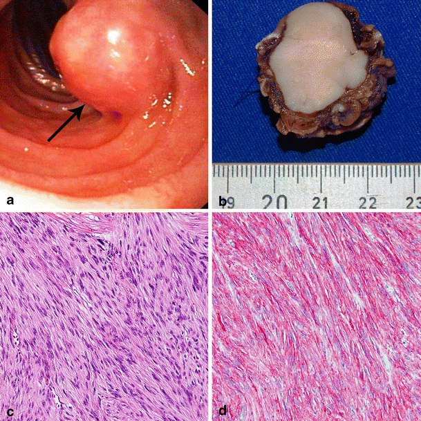 Duodenal Gist A Single Center Experience Springerlink 0062