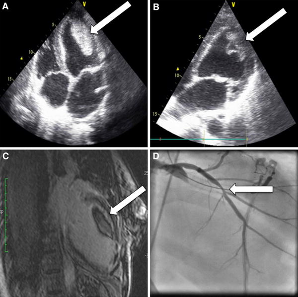 Mobile left ventricular thrombus in left ventricular dysfunction: case report and review of ...