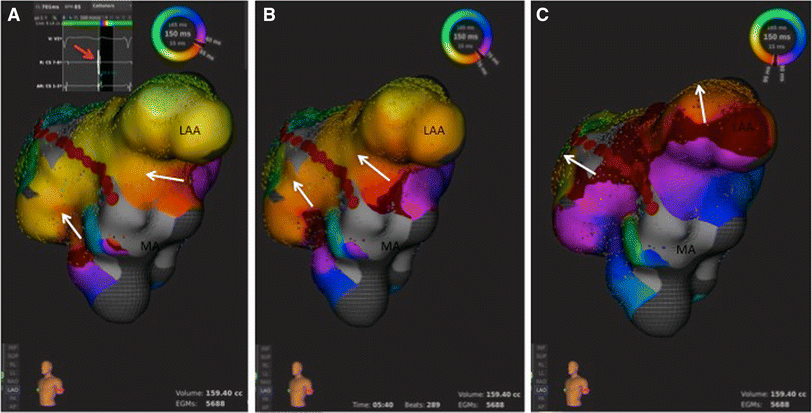 atrial flutter ablation atrial flutter ablation