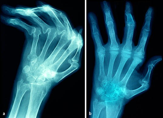 Endoprothetik des Fingergrundgelenks | SpringerLink