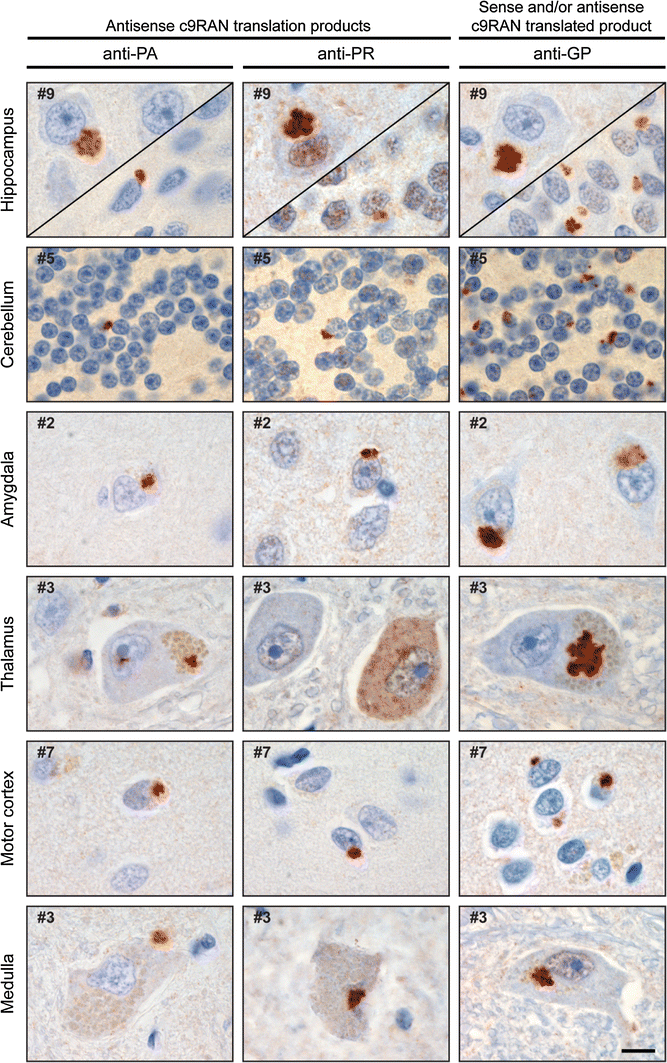 Antisense transcripts of the expanded C9ORF72 hexanucleotide repeat ...