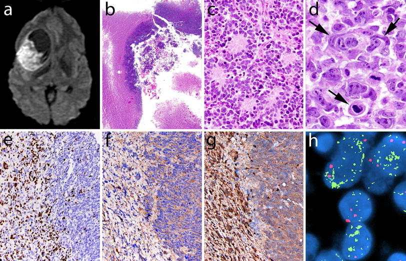 The 2016 World Health Organization Classification Of Tumors - 